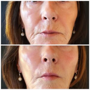 Radiesse Dermal Filler