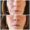 Radiesse Dermal Filler