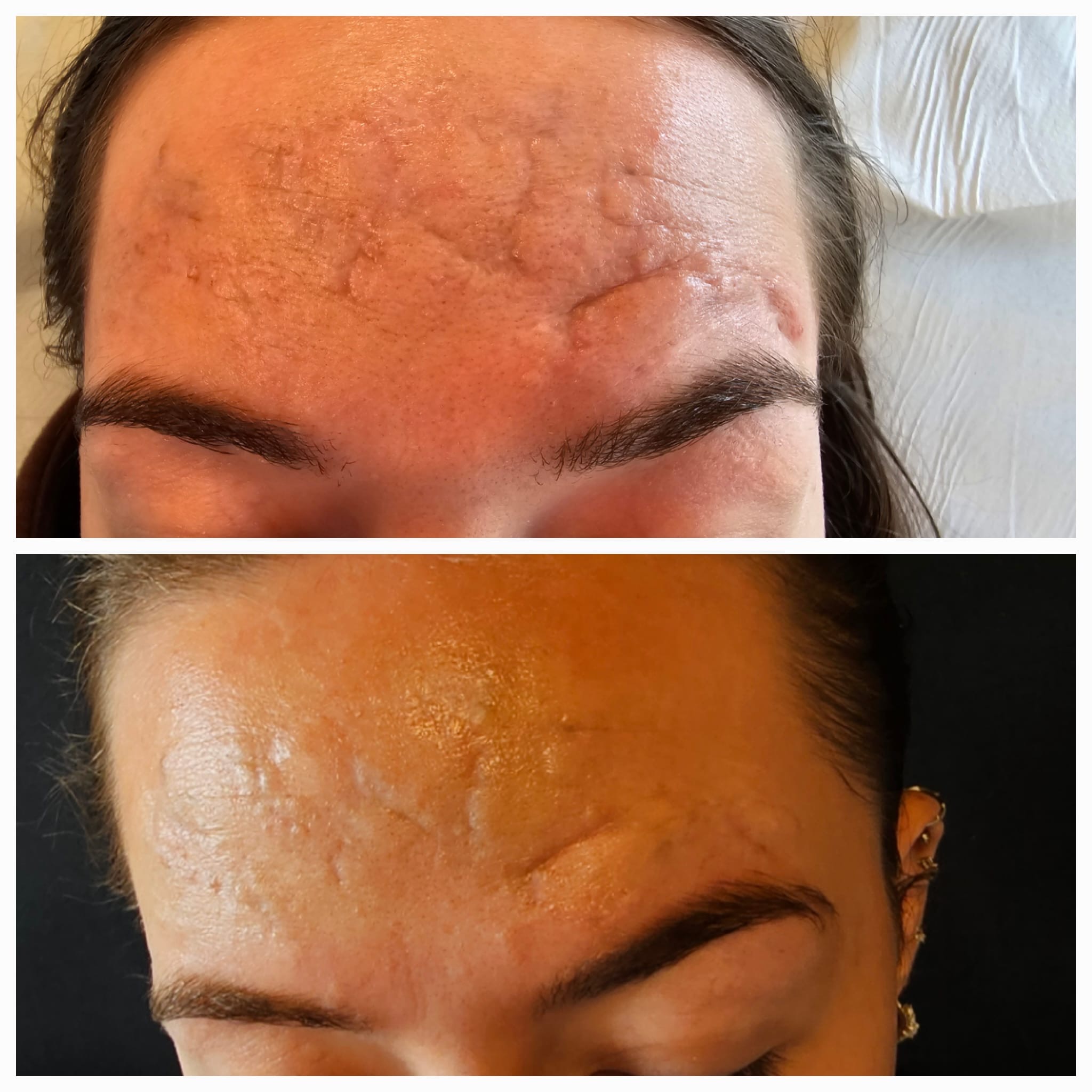 One Treatment with Dermapen, exosomes & Polynucleotides