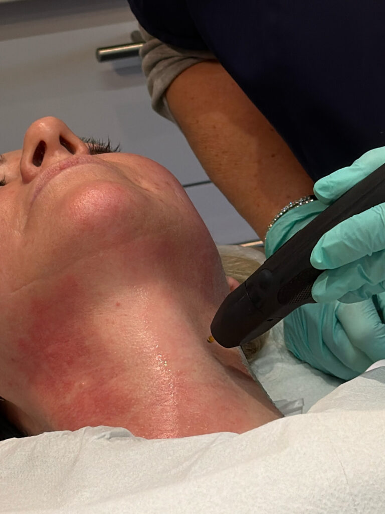 NeoGen Skin Regeneration Treatment