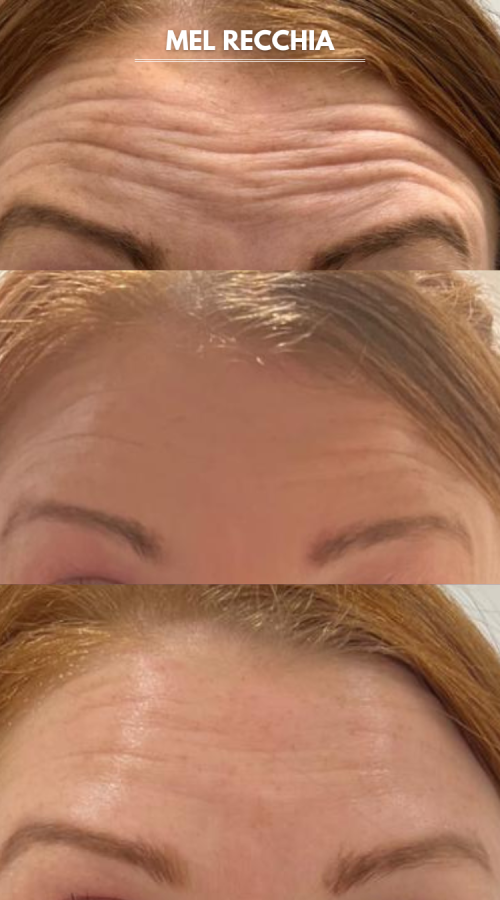 Anti_wrinkle_treatment_alchemy_skin_clinic