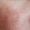 Close up of human face skin with vascular problems, couperose on sensitive skin