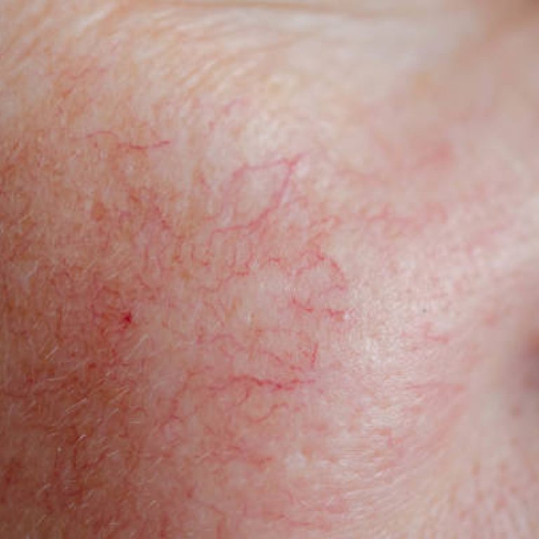 Close up of human face skin with vascular problems, couperose on sensitive skin