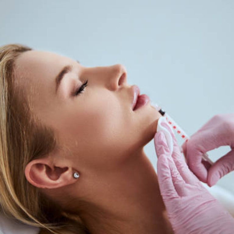 Side view of a woman undergoing the lip augmentation procedure done in a beauty salon