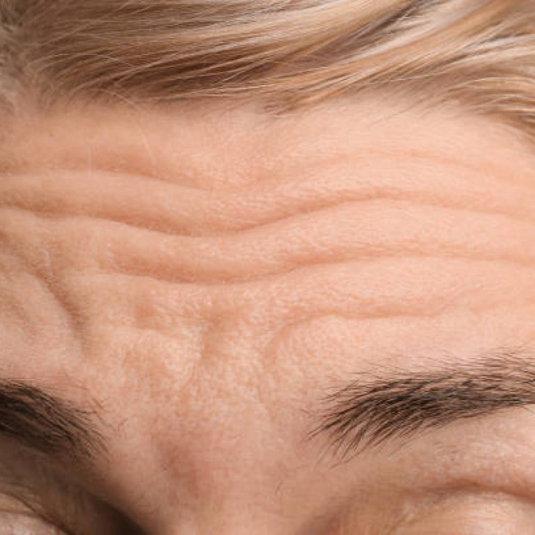Close-up wrinkles. Facial treatments. Anti-aging program, concept. Removal of wrinkles, age-related changes. Cosmetology, beautician hands.